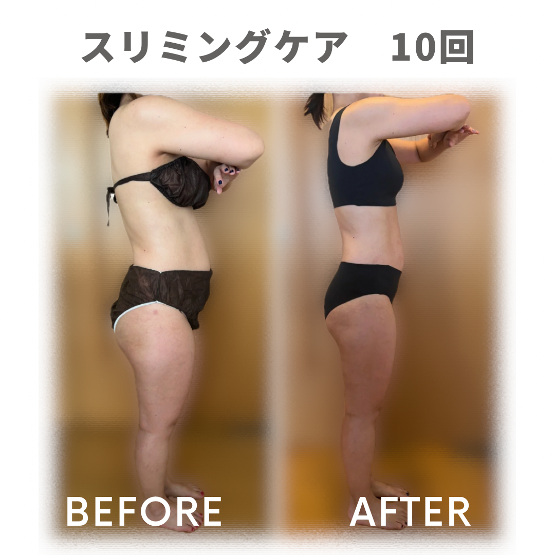 スリミングケア10回：体型ビフォーアフター